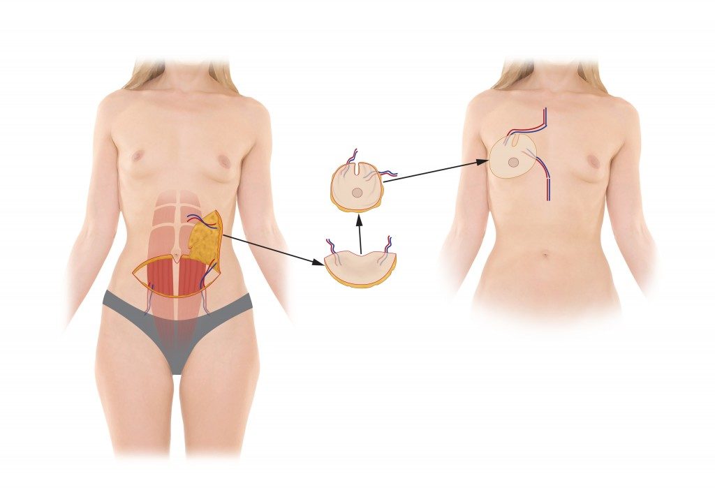 Breast Reconstruction Royal Oak MI