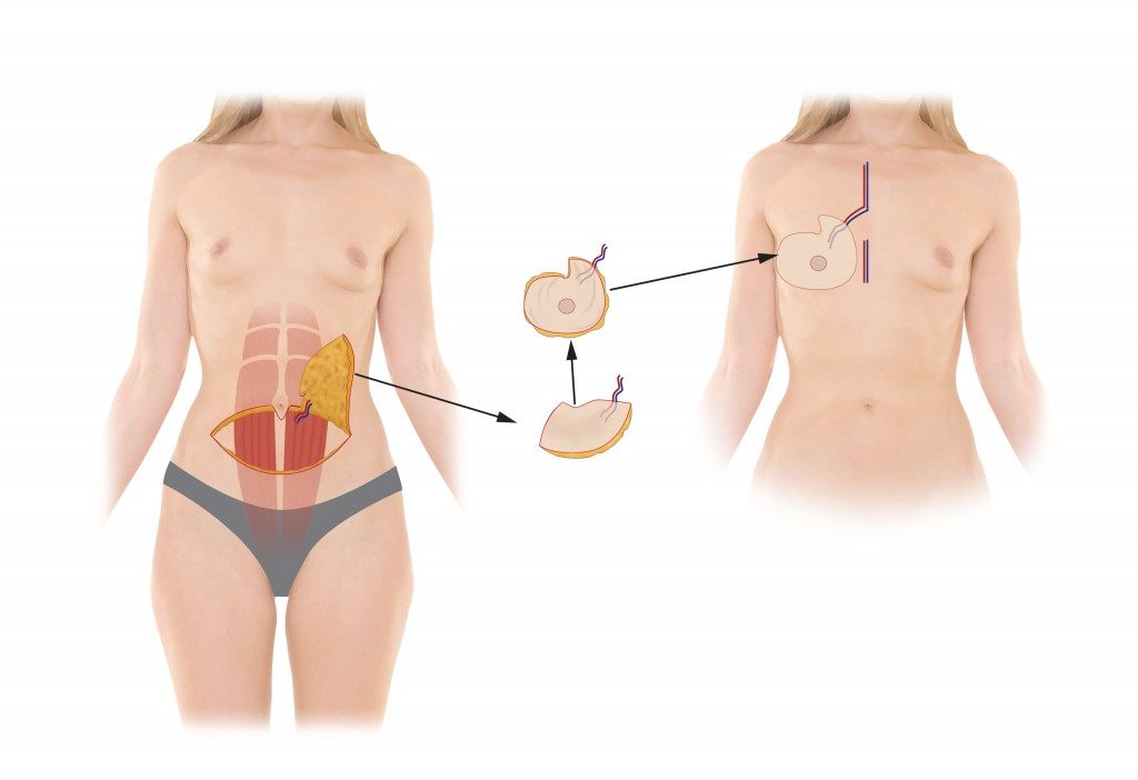 Breast Reconstruction Royal Oak MI