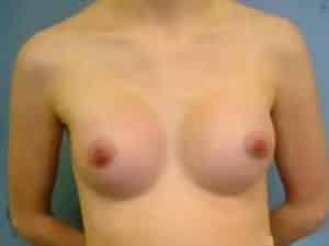 Breast Augmentation