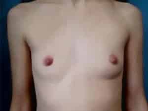 Breast Augmentation