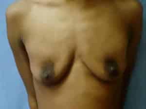 Breast Augmentation