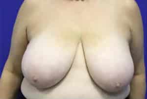 Breast Reduction