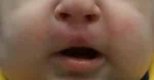 Bilateral Cleft Lip