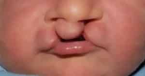 Bilateral Cleft Lip