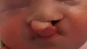 Bilateral Cleft Lip