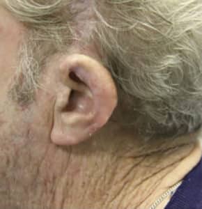Ear Reconstruction