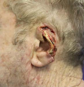 Ear Reconstruction